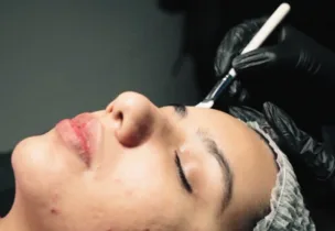 Illustrative placement: AcneOUT Peel
