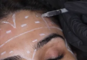 Illustrative placement: Botox for Forehead Lines