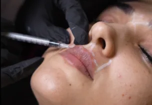 Illustrative placement: Botox Lip Flip
