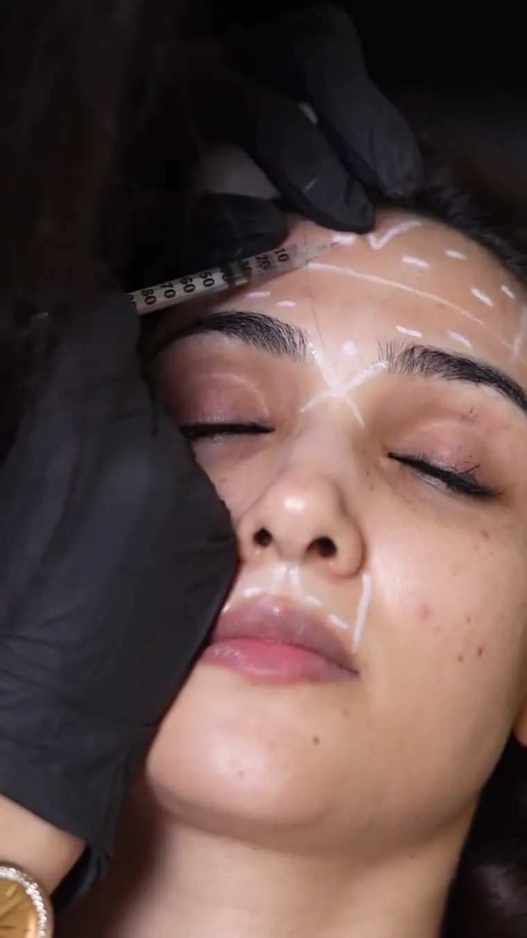 Illustrative placement: Botox Treatments