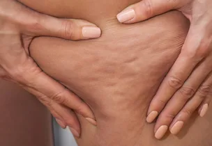 Illustrative placement: Cellulite Treatment