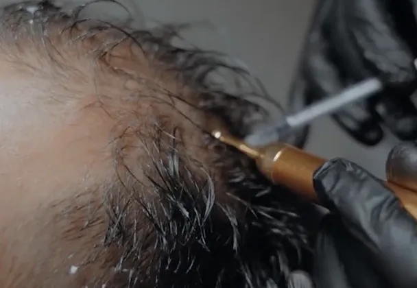 Illustrative placement: Hair Mesotherapy