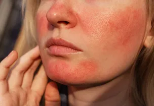 Illustrative placement: Rosacea Treatment