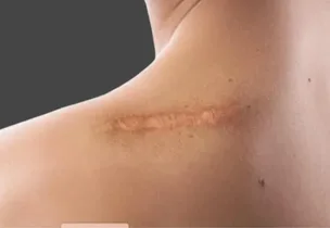 Illustrative placement: Scar Improvement Treatment