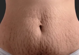 Illustrative placement: Stretch Mark Treatment