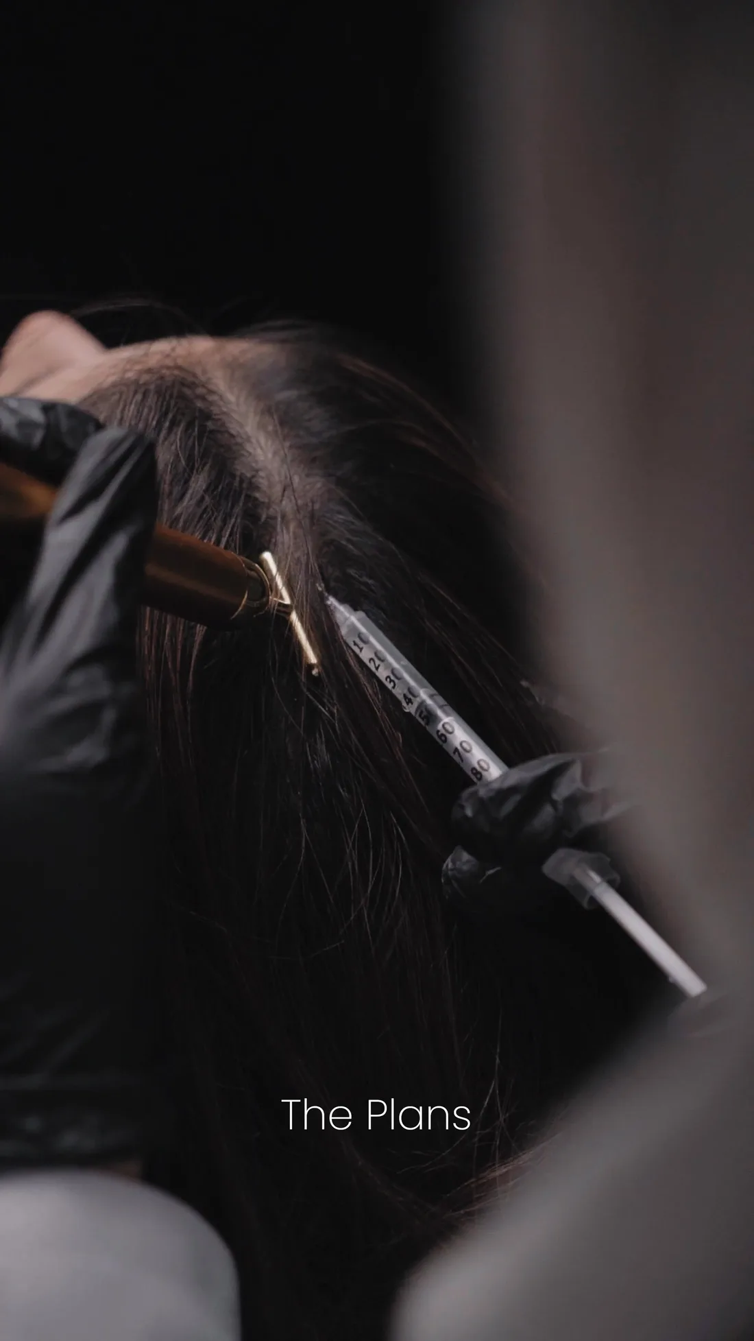 Illustrative placement: Hair Transplant