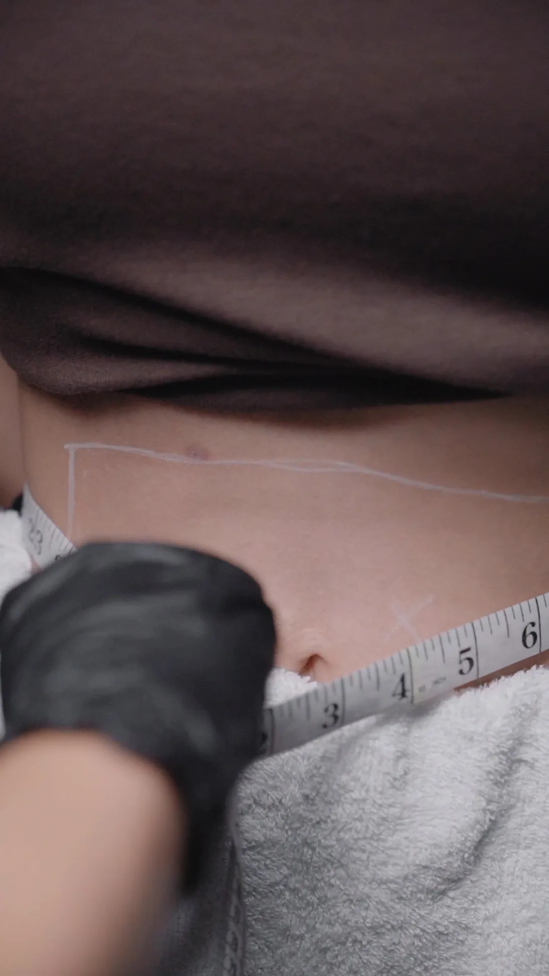 Replaceable sample body, surgery & weight management image
